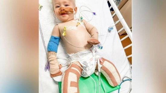 Menino de 1 ano que estava internado com coriza tem pernas e dedos amputados por infecção - Reprodução/ Redes Sociais