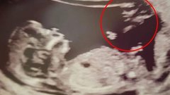 Ela se surpreendeu no ultrassom de 12 semanas - reprodução / Getty Images