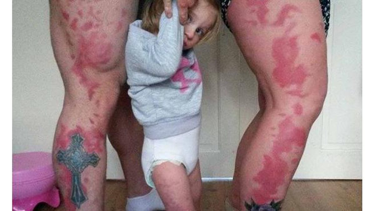 Imagem Pais fazem tatuagem que imita manchas da filha
