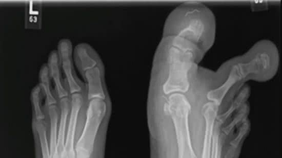 Menina tem gigantismo nos dedos do pé por condição rara - (Foto: reprodução/Cureus)