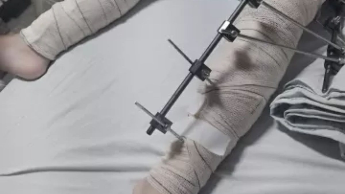 Médicos operam perna errada de criança que caiu de bicicleta - (Foto: reprodução/TV Cabo Branco)