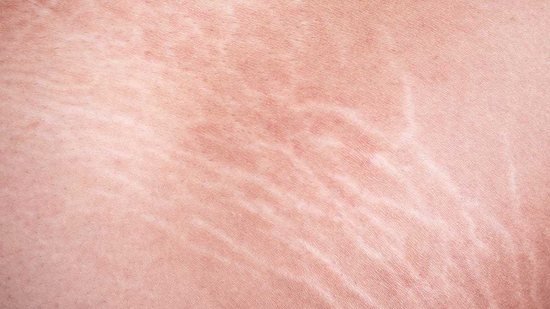 As estrias são lesões na pele que acontecem por causa do rompimento das fibras colágenas e elásticas, que são responsáveis por dar firmeza à pele. - Shutterstock