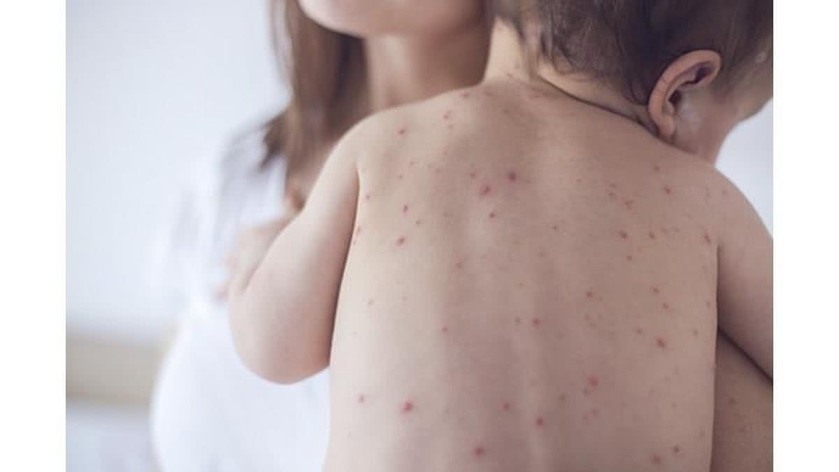 Um dos sintomas da doença incluem manchas vermelhas espalhadas pelo corpo - Getty Images
