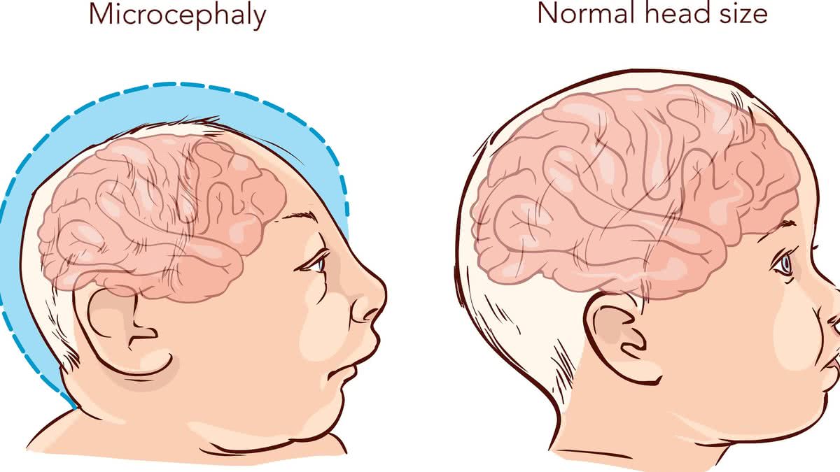 Ilustração de um bebê recém-nascido com microcefalia causada pelo Zika vírus - Getty Images