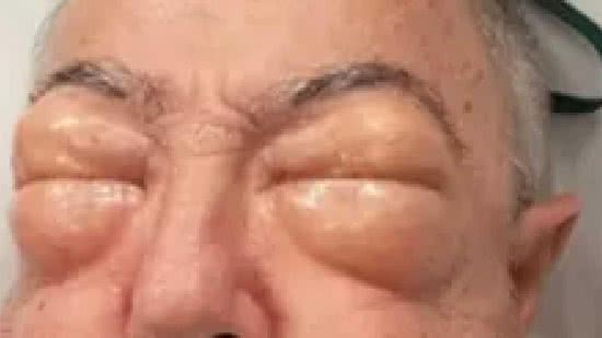 Um australiano de 75 anos teve corpo e rosto alterados após passar por cirurgia - Divulgação/Epworth HealthCare