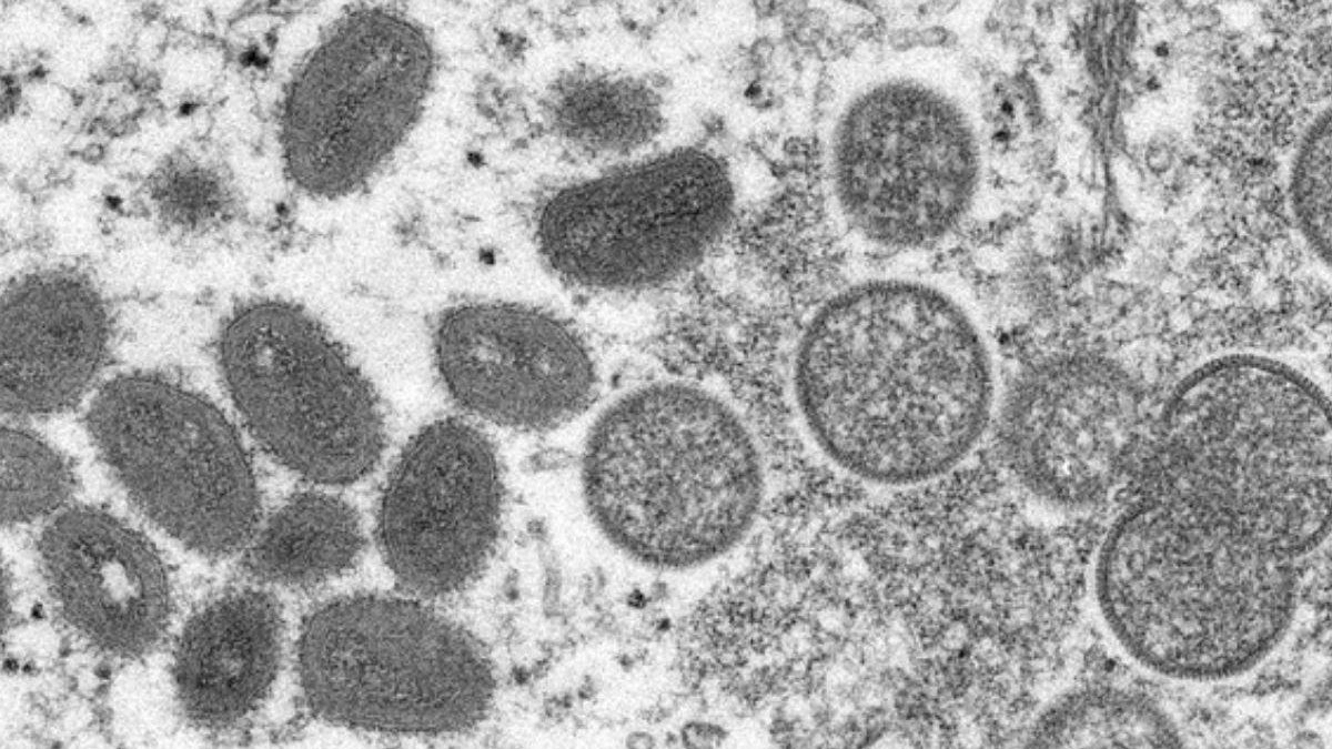 Varíola do macaco: quais os sintomas e o que se sabe até o momento sobre a doença