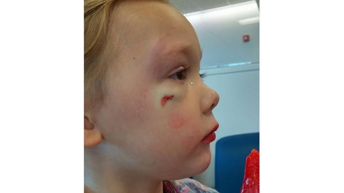 Filha de Merritt com o rosto machucado - Foto: Facebook