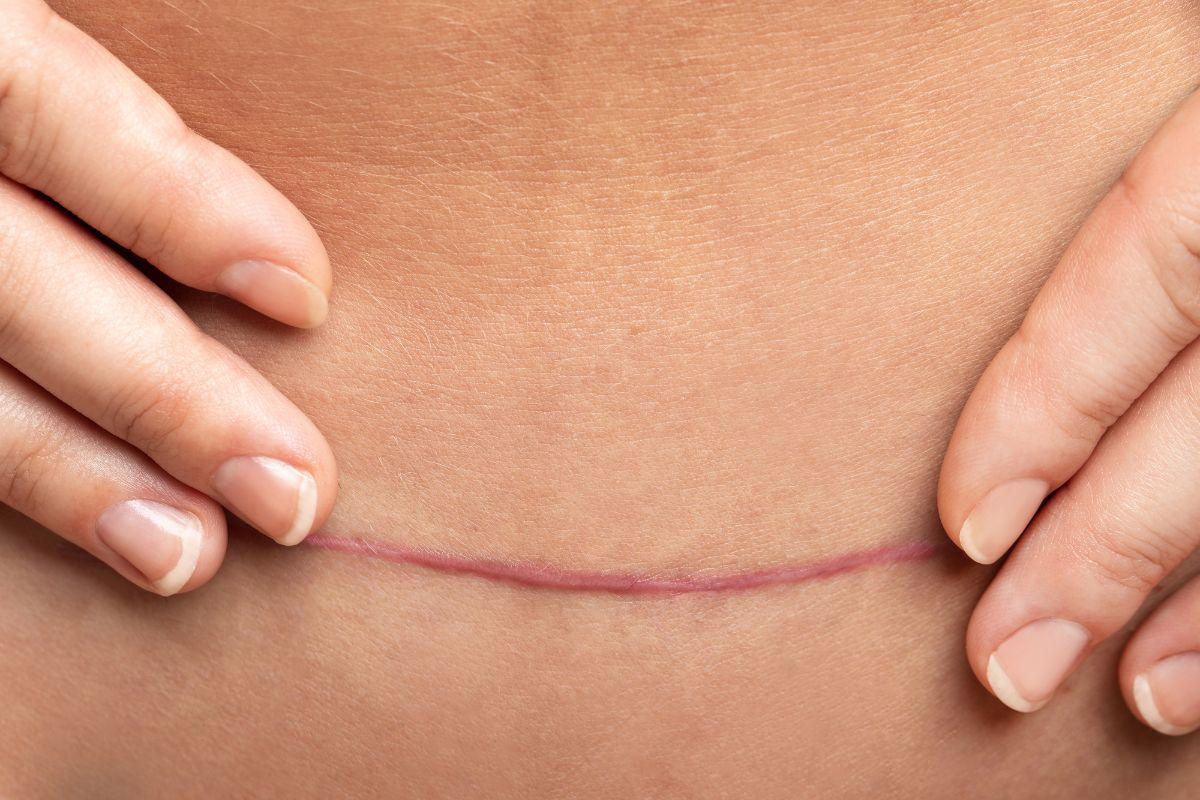Cicatriz da cesárea: como cuidar e quais tratamentos ajudam a melhorar a  aparência
