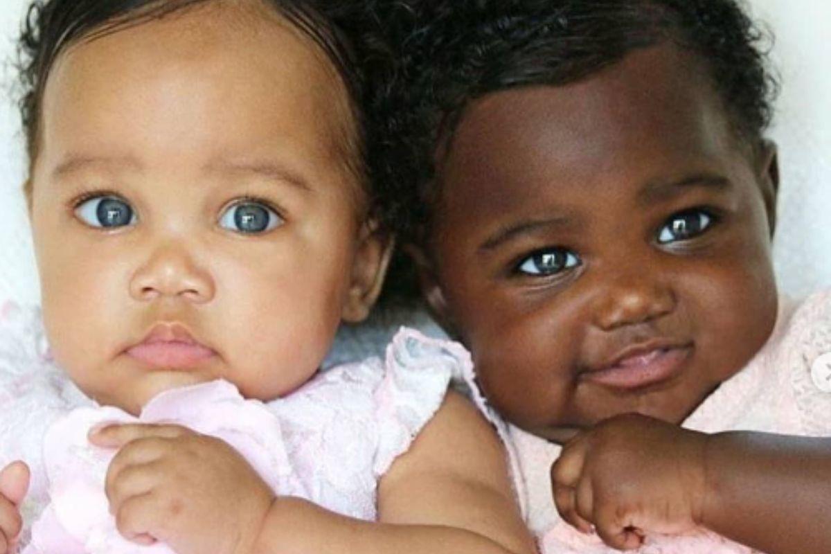 Gêmeas nascem com tonalidades de pele diferente